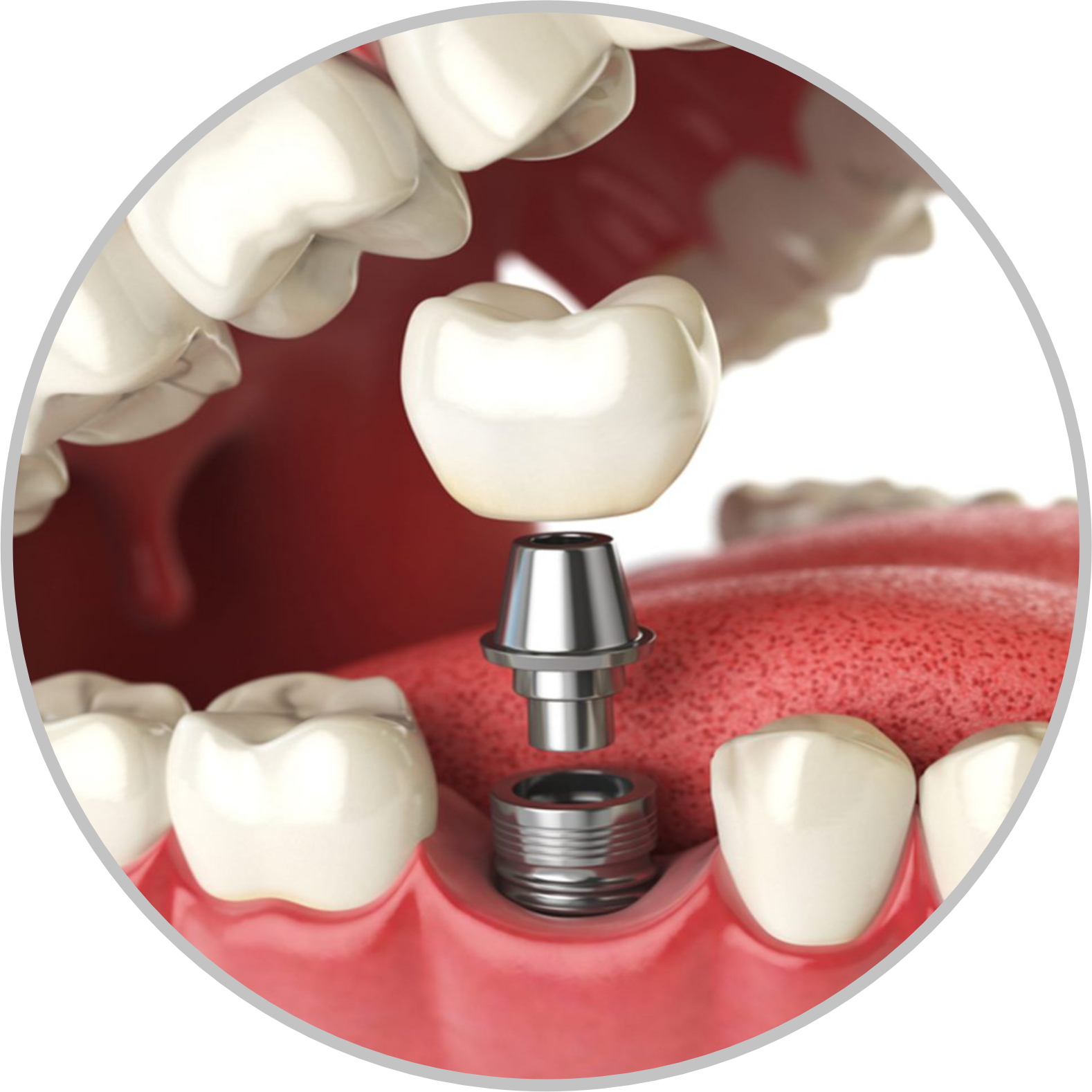 Dental Implants