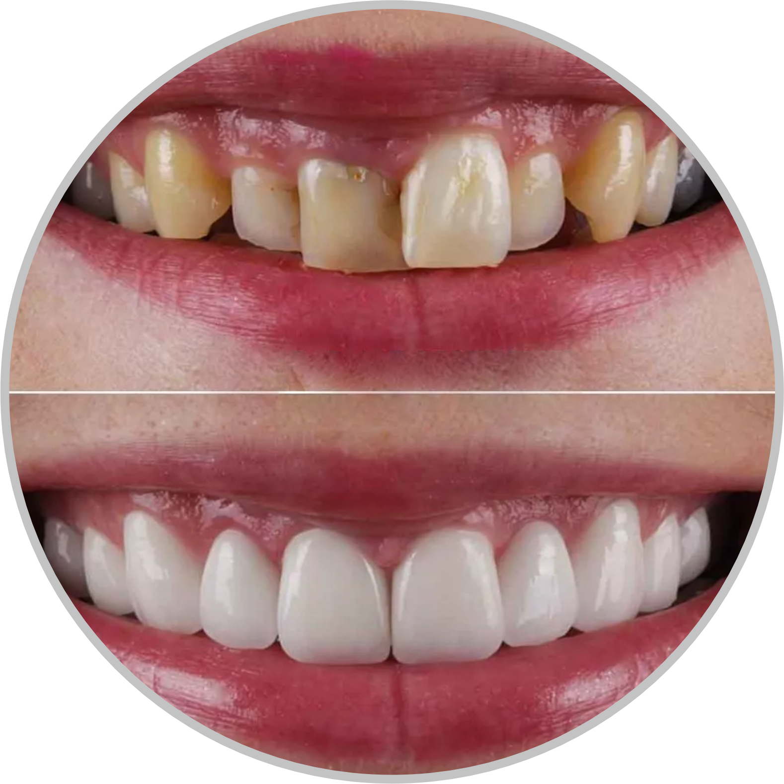 gum-contouring