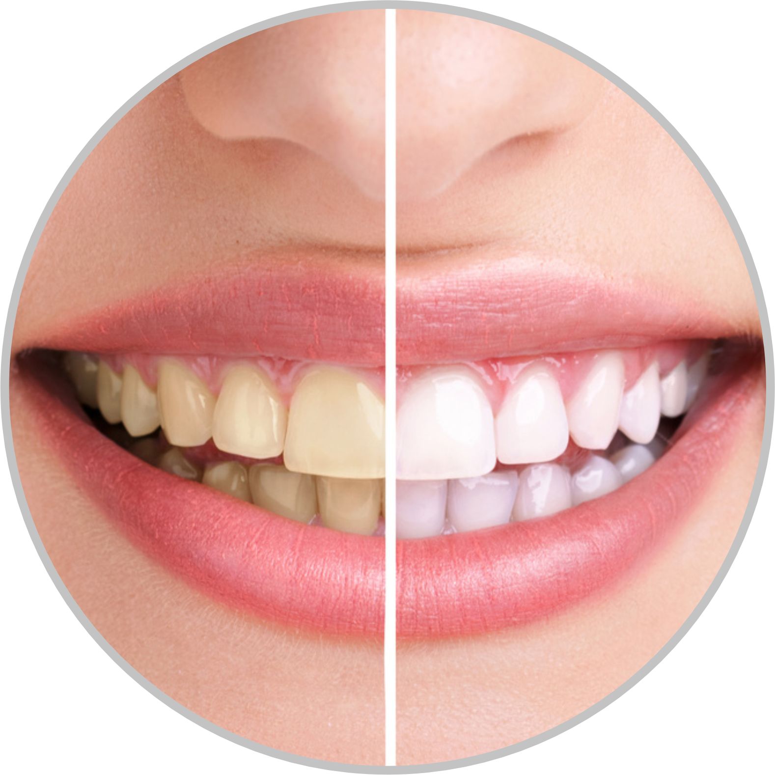 Teeth Whitening