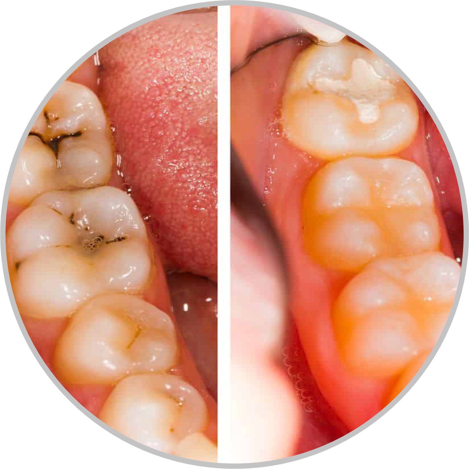Tooth-colored fillings