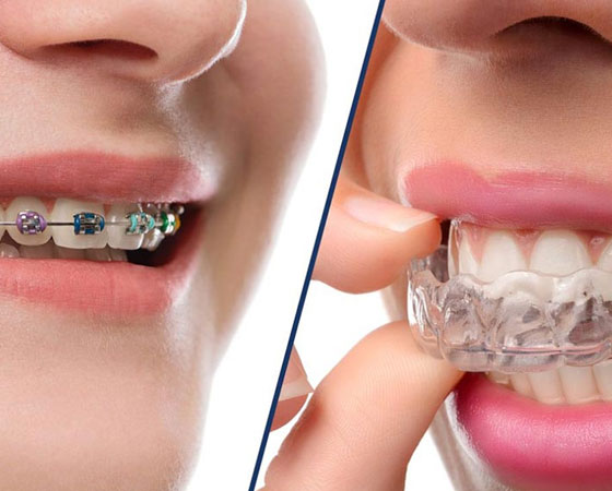 Wisdom Tooth Treatment